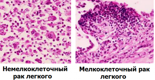 Немелкоклеточный и мелкоклеточный рак легкого