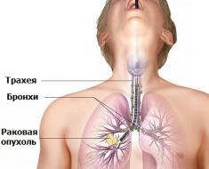 Методы распознавания рака легких