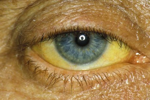 Желтоватый цвет белков глаз