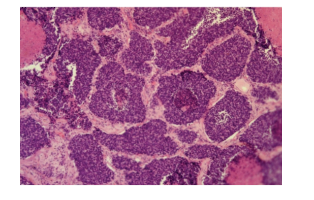 Мелкоклеточный рак легкого под микроскопом