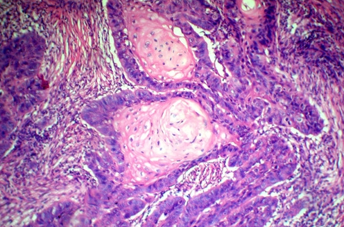 Плоскоклеточный рак. Гистология