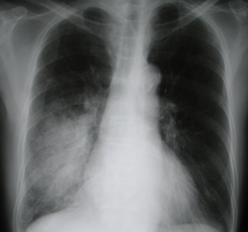 Пневмония на рентгеновском снимке