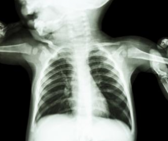 Рентгеновский снимок легких ребенка