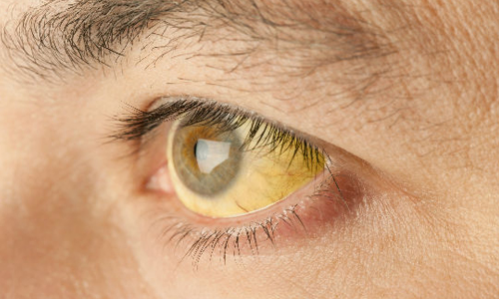 Желтизна белков глаз