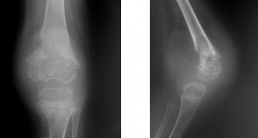 Теберкулез костей человека на рентгеновском снимке