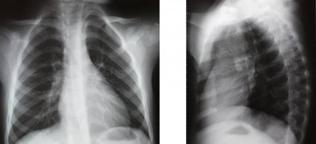 Рентген легких в 2-х проекциях