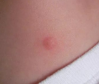 Сыпь у ребенка после бцж thumbnail