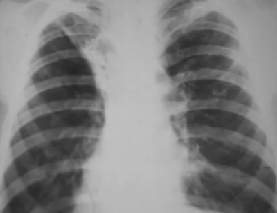 Цирротический туберкулёз