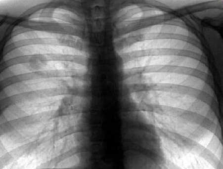 Туберкулема лёгкого