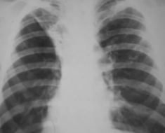 Цирротический туберкулёз